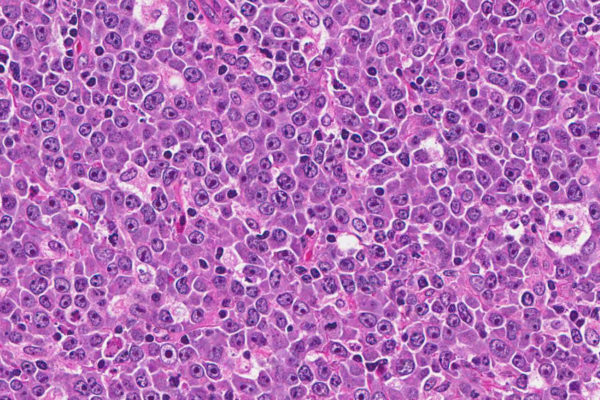 Lymphomas